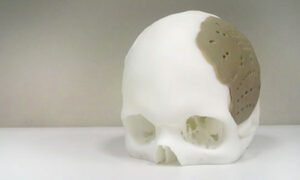 3D Yazıcı Implant
